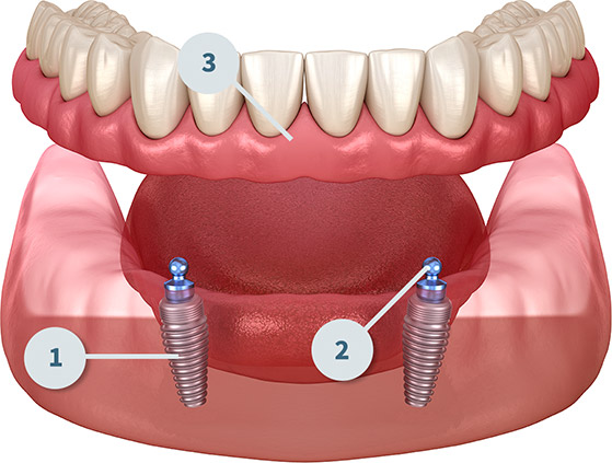 Implant Denture