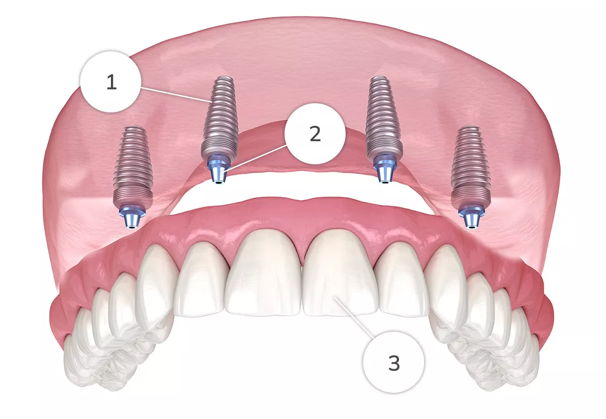 Fixed implant bridge